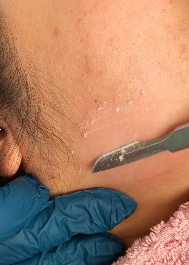 DERMAPLANING VANCOUVER